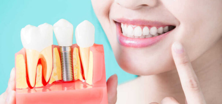 Восстановление уверенности: Как зубные импланты меняют жизнь пациентов
